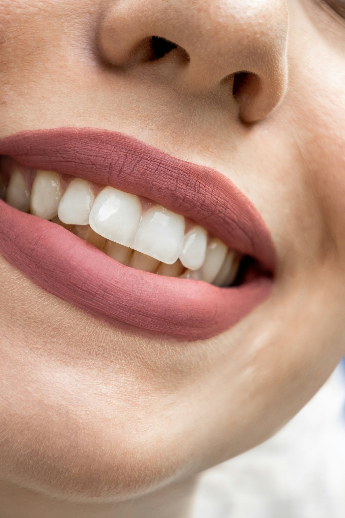 Sorriso natural recuperado com prótese fixa